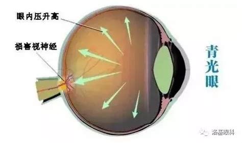 視野變小|青光眼是什麼、怎麼辦？青光眼症狀有哪些，醫師說明如何檢測與。